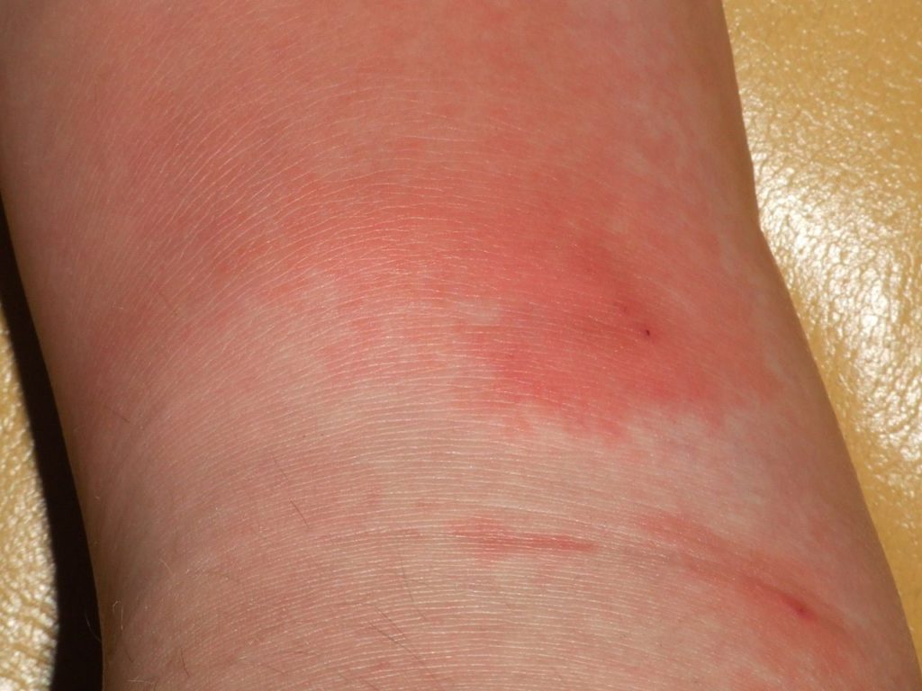 Celulitis-1024x768