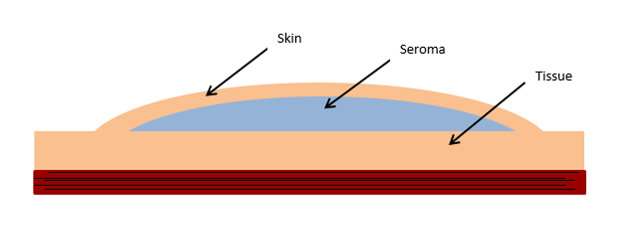 Seroma